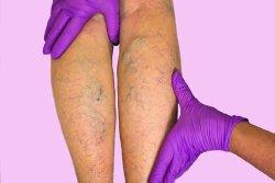 provides sclerotherapy for patients with spider veins
