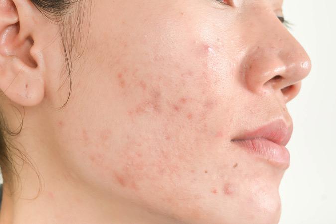 Dr Ronald B. Prussick, Washington Dermatology Center Describing Dermal Needling reviews
