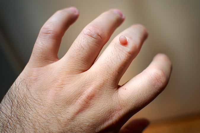 Bethesda MD has a solution to warts
