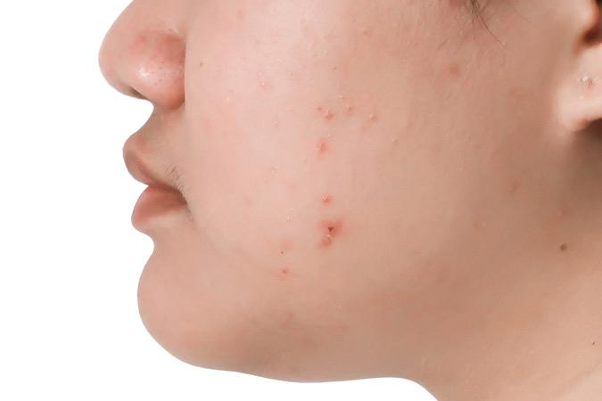 Dr Ronald B. Prussick, Washington Dermatology Center Providing Micro Needling Therapy