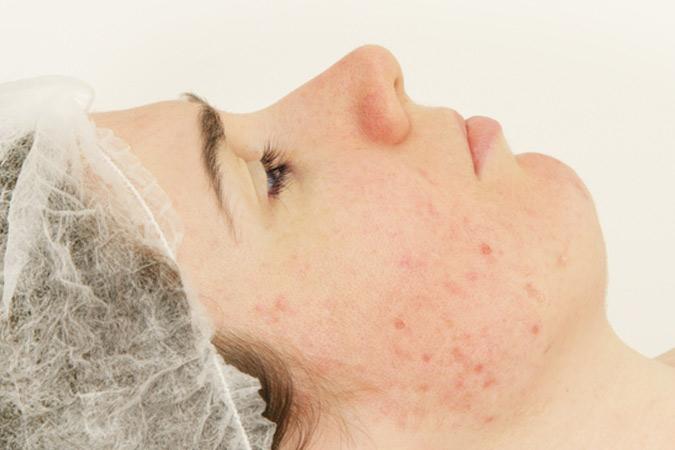 Dr Ronald B. Prussick, Washington Dermatology Center Using Micro Needling Device