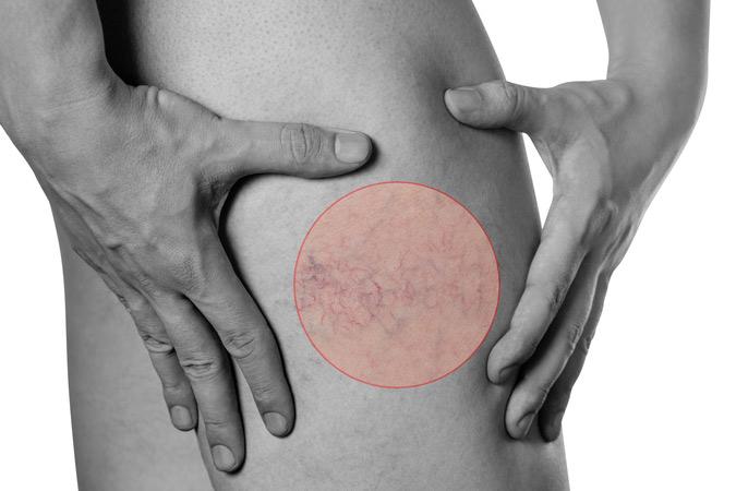 Dr Ronald B. Prussick, Washington Dermatology Center Providing Treatment For Spider Veins