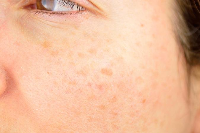 Dr Ronald B. Prussick, Washington Dermatology Center Providing Treatment For Sunspot