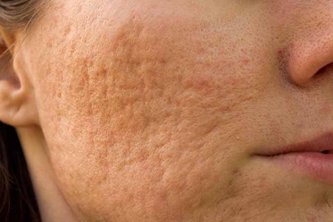 dermatologist describes what to use for acne scars