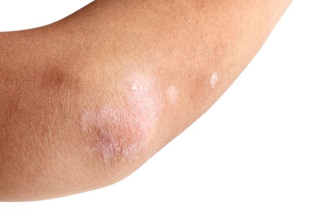 Itchy skin relief from dermatologist in Rockville MD