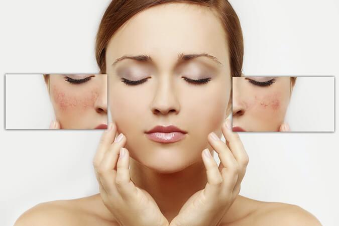 Medication for Rosacea Rockville MD