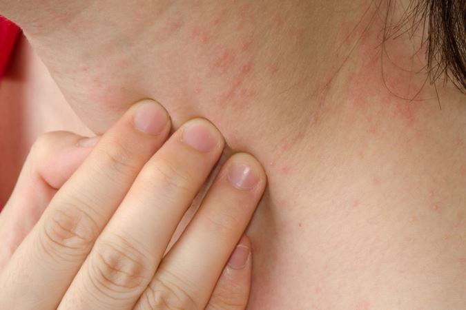 Psoriasis Dermatologist in Maryland