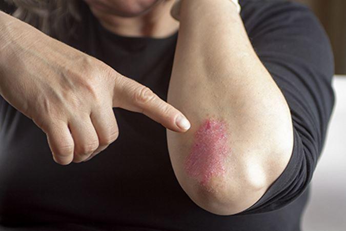 Variety of treatment options from Psoriasis expert in the Rockville, MD