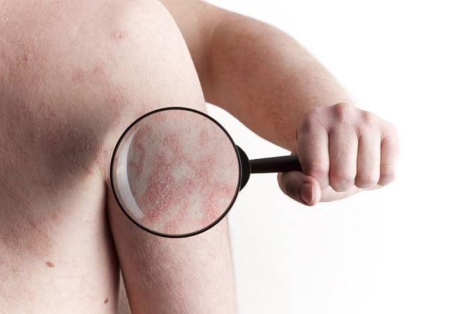 Rockville area dermatologist describes psoriasis causes and treatment options