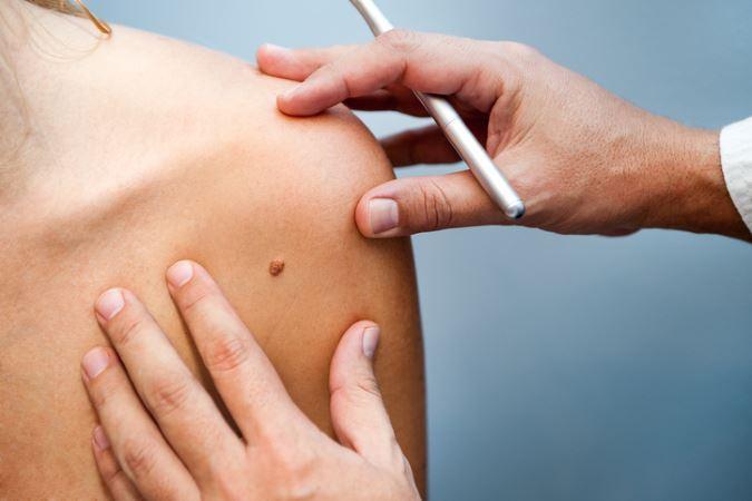skin cancer treatment from dermatologist in Bethesda MD