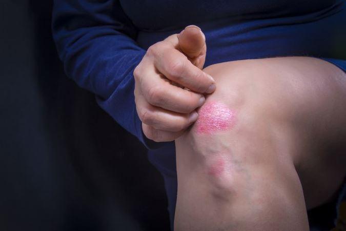 Psoriasis learn more from dermatologist in fredrick