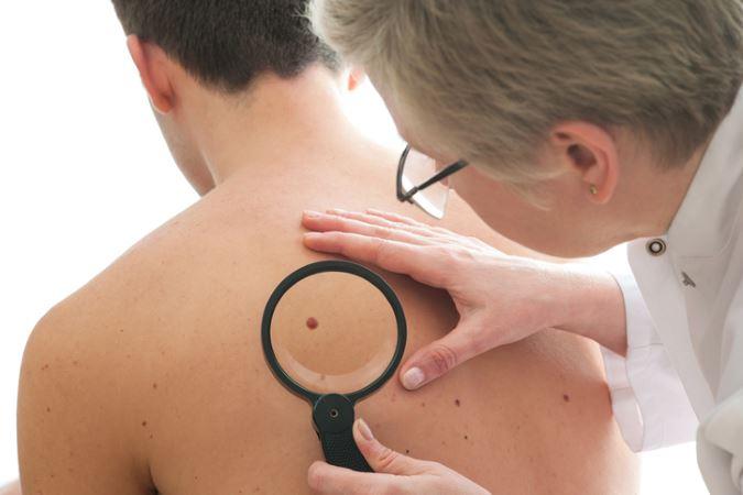 What is squamous cell carcinoma learn more from dermatologist in potomac