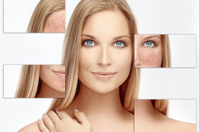Symptoms of Rosacea Rockville