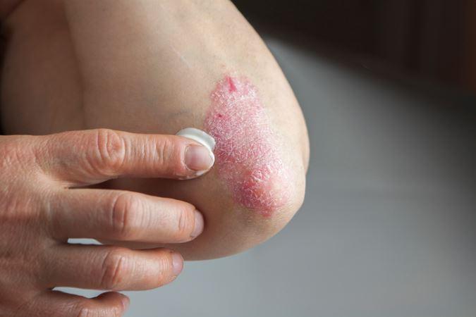 Treating Psoriasis from dermatologist in Frederick