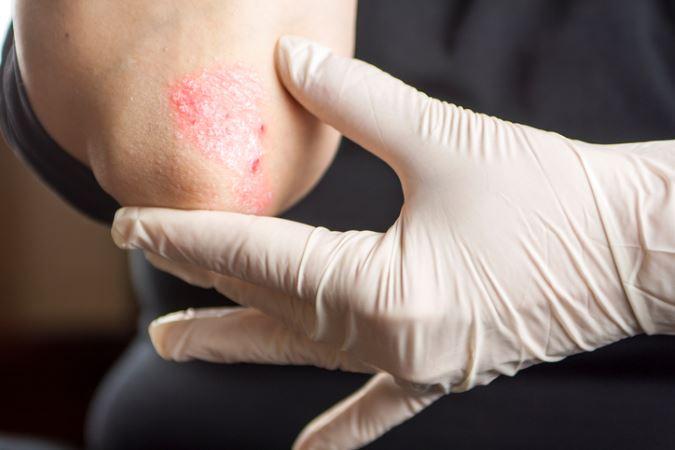 Treatment Psoriasis from dermatologist in Bethesda
