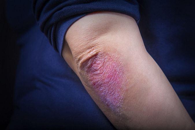 Ultraviolet Treatment for Psoriasis from dermatologist in Rockville MD