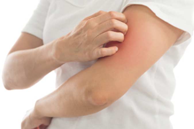 Applying an cream emollient to dry flaky skin as in the treatment of psoriasis