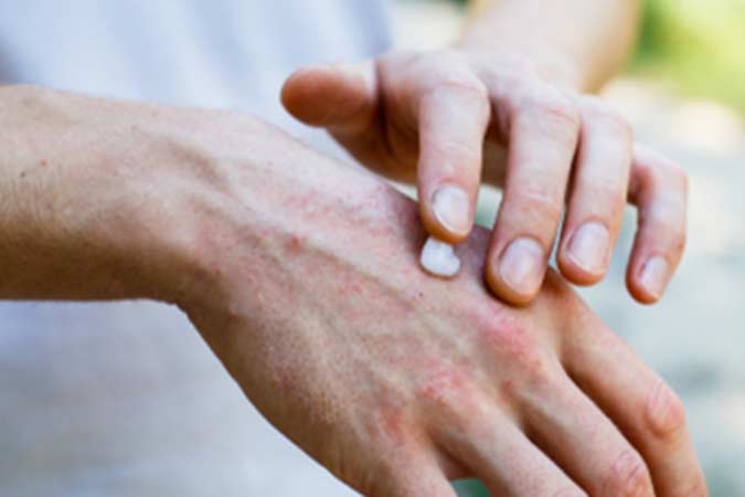 Applying an cream emollient to dry flaky skin as in the treatment of psoriasis