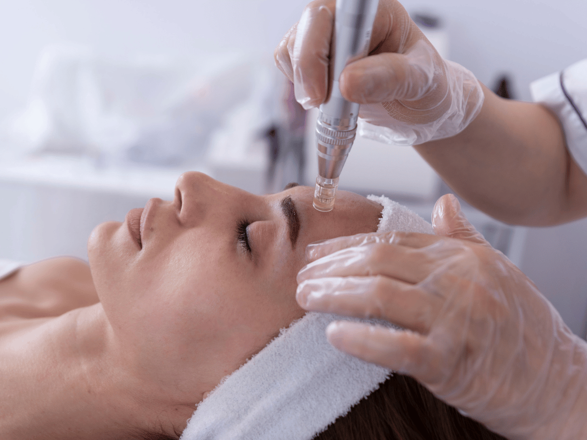 Microneedling treatment